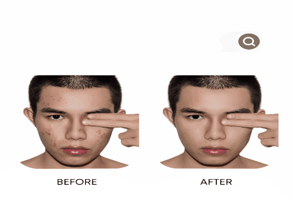 Organic Anti - Acne Three - Step System - Moderate/Severe Acne Prone Skin - For MEN - Tiny Tim SkincareOrganic Anti - Acne Three - Step System - Moderate/Severe Acne Prone Skin - For MENfacial wash and moisturize packOnyx Skin Care LineTiny Tim Skincare6552553937365525539373Anti - AcneOrganic Anti - Acne Three - Step System - Moderate/Severe Acne Prone Skin - For MEN