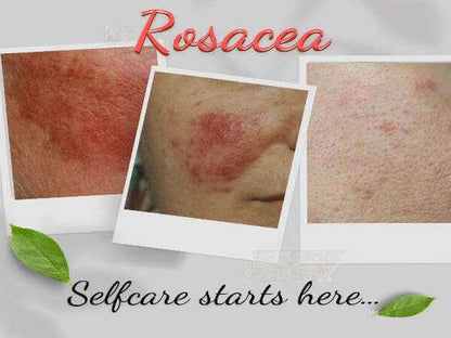 Organic Moisturizer for Rosacea Prone Skin - For Women &amp; Men - Tiny Tim SkincareOrganic Moisturizer for Rosacea Prone Skin - For Women &amp; Menfacial wash and moisturizerOnyx Skin Care LineTiny Tim Skincare655457646358655447646358Organic Moisturizer for Rosacea Prone Skin - For Women &amp; Men